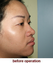 plastic_surgery_augmentation_rhinoplasty